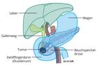 Pankreastumor-Bauchspeicheldrüsentumor-Kopfsegment