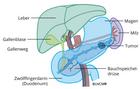 Pankreastumor-Bauchspeicheldrüsentumor im Schwanzsegment