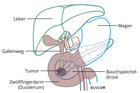 Resektionsausmass bei Tumor im Pankreaskopf