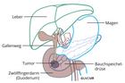 Resektionsausmass bei Tumor im Pankreaskopf