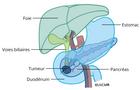 Tumeur pancréatique au niveau du segment de tête