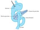 Situation après résection segmentaire du pancréas