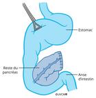 Situation après la résection pancréatique gauche