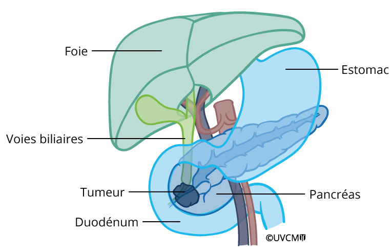 Tumeurs du pancréas | Pankreaszentrum Bern